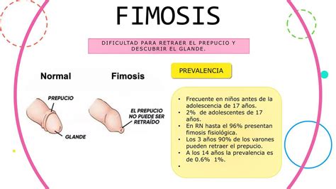 Image: Fimosis